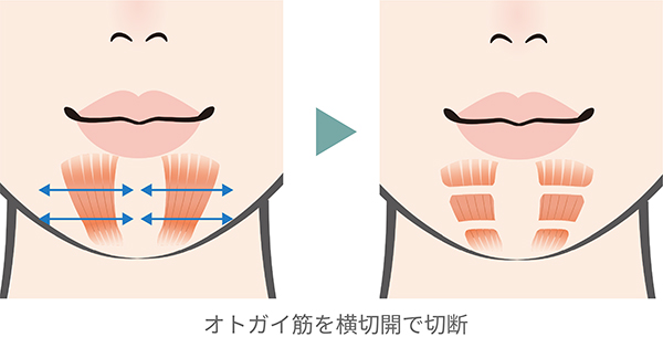 オトガイ筋を横切開で切断