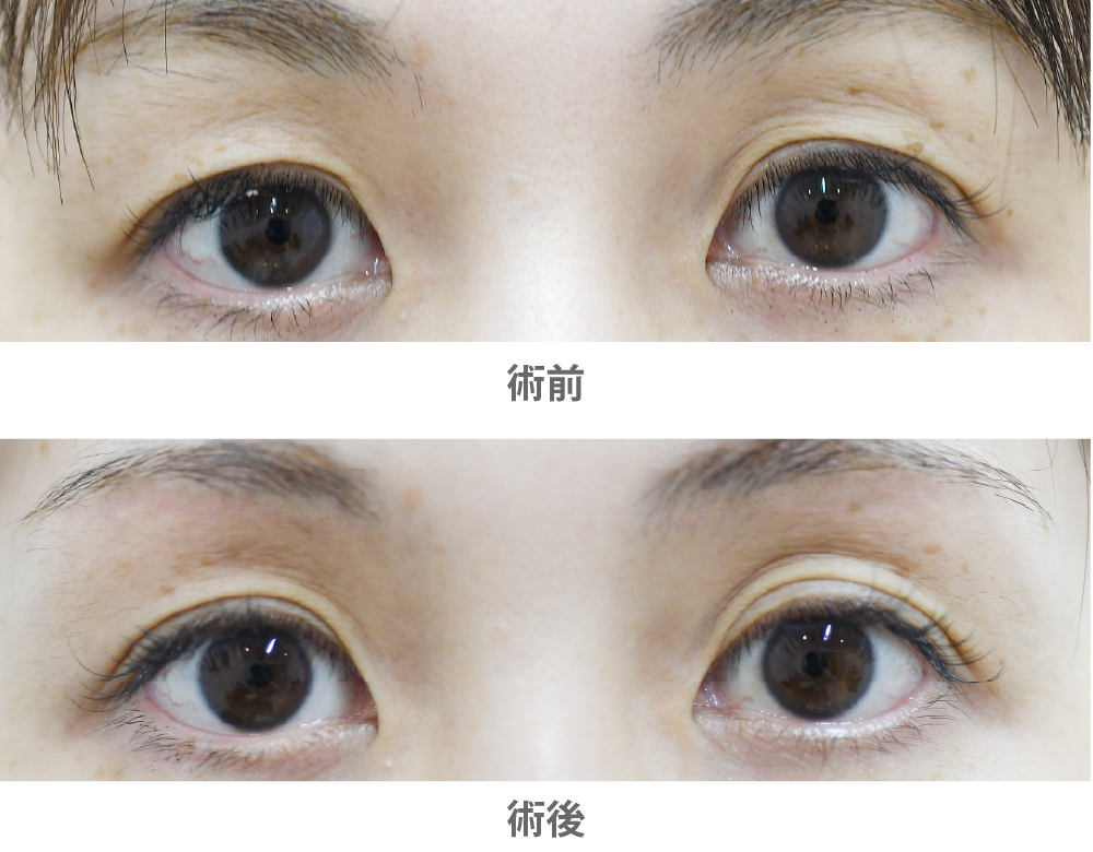 「眉下切開(上まぶたのたるみ取り)」の症例写真・ビフォーアフター