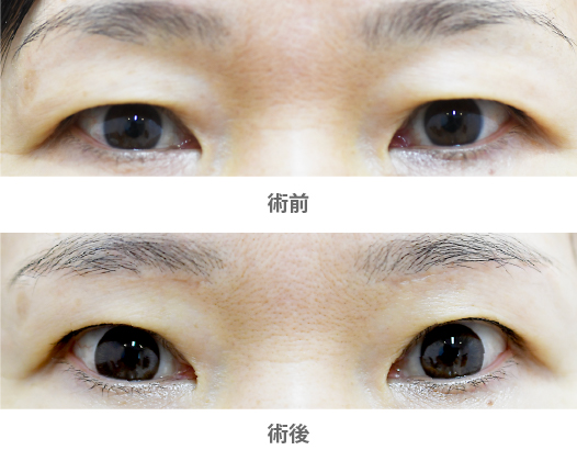 「眉下切開・こめかみリフト（上まぶたのたるみ取り）」の症例写真・ビフォーアフター