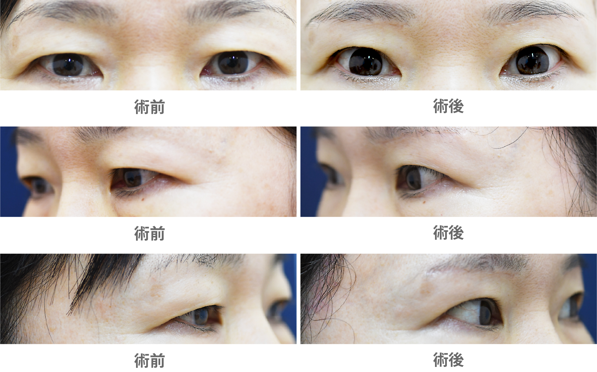 「眉下切開・こめかみリフト（上まぶたのたるみ取り）」の症例写真・ビフォーアフター