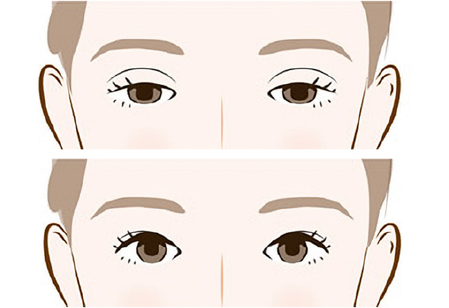 眉下の皮膚を切開して上まぶたのたるみを除去する
