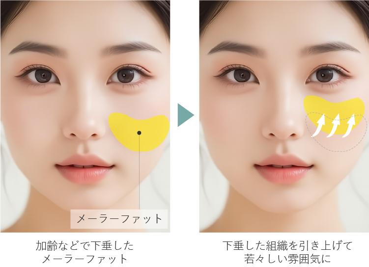 根本改善を目的としたリフト術