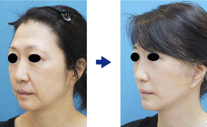 58歳女性のフェイスリフト症例／頬・輪郭・ほうれい線改善（効果には個人差があります）