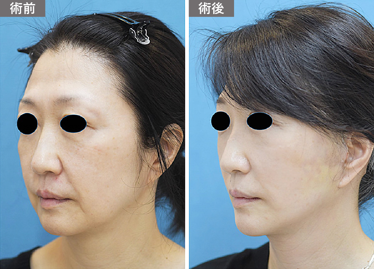 「頬のたるみ」の症例写真・ビフォーアフター