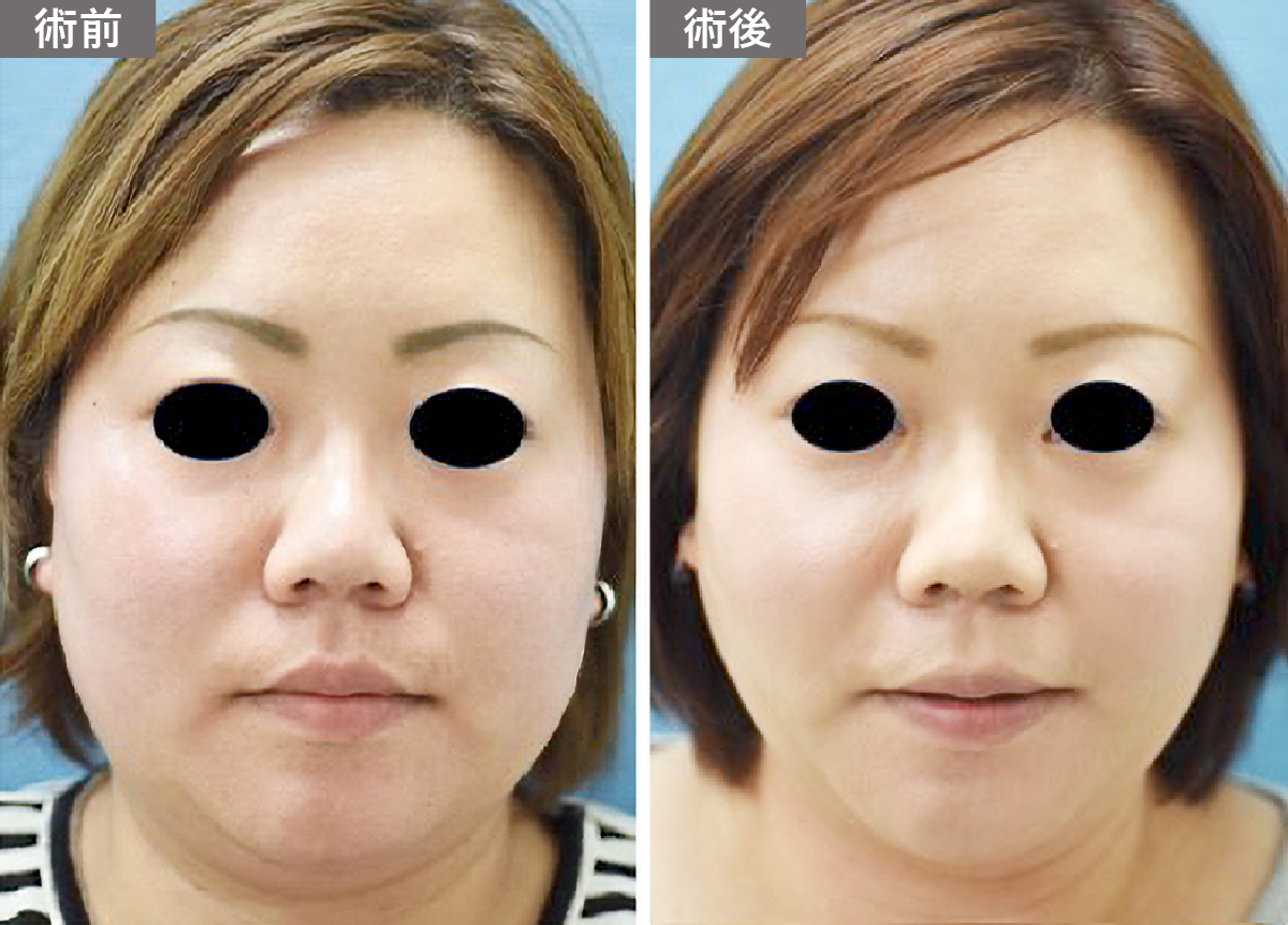 「顎下のたるみ・二重顎」の症例写真・ビフォーアフター