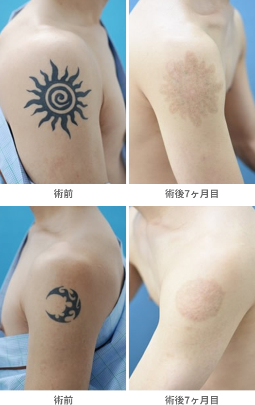 「削皮術（炭酸ガスレーザー）による刺青除去」の症例写真・ビフォーアフター