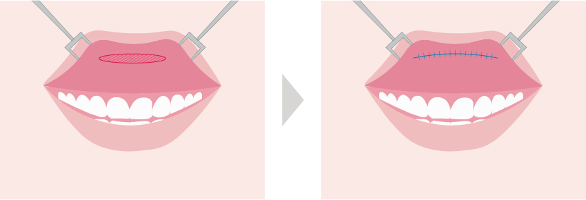 上唇の裏側（口腔内・粘膜側）を切開して行う施術です