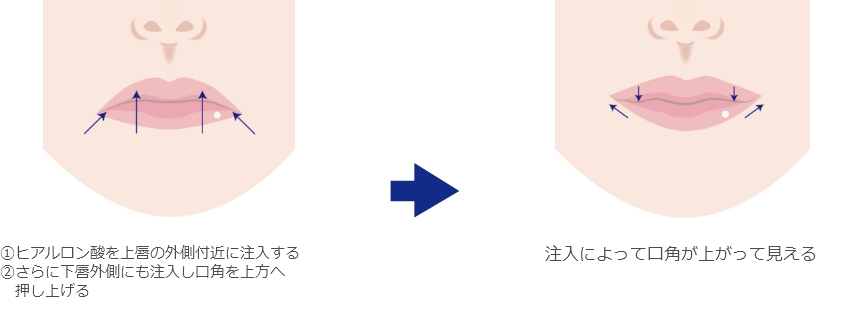 ヒアルロン酸注入よる口角挙上術（スマイルリップ）