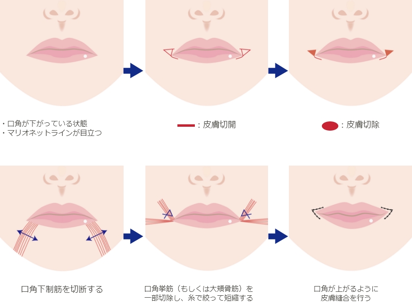 口角挙上術（皮膚切開）による口角挙上術（スマイルリップ）