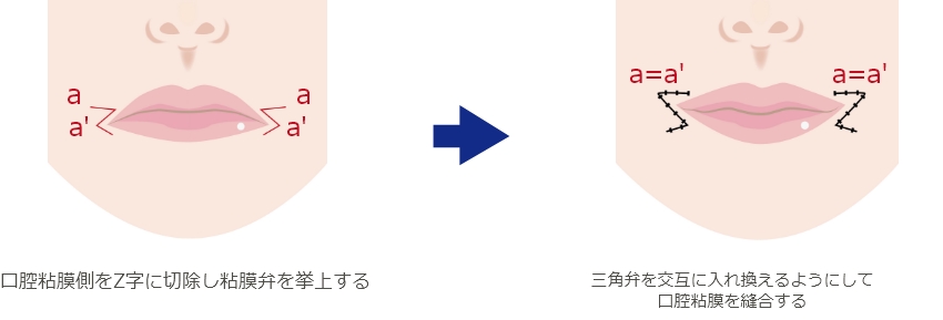 口角挙上術（粘膜切開）による口角挙上術（スマイルリップ）