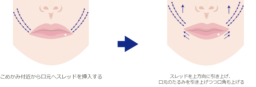 スレッドリフトによる口角挙上術（スマイルリップ）