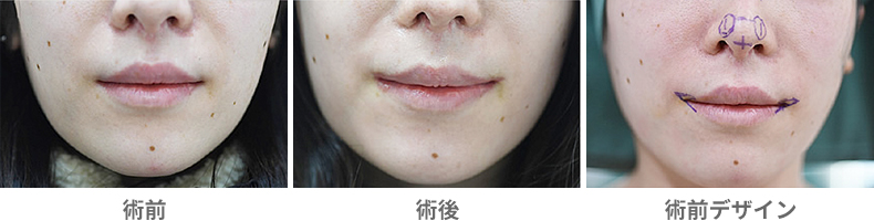 「皮膚切除による口角挙上術（スマイルリップ）」の症例写真・ビフォーアフター
