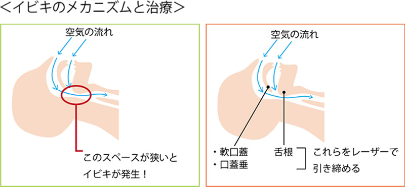 イビキのメカニズムと治療