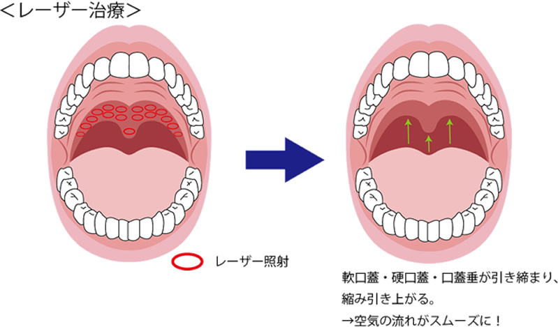 レーザー治療