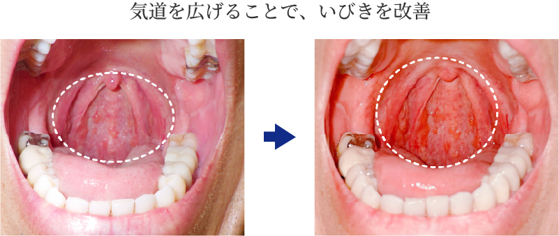 気道を広げることで、いびきを改善