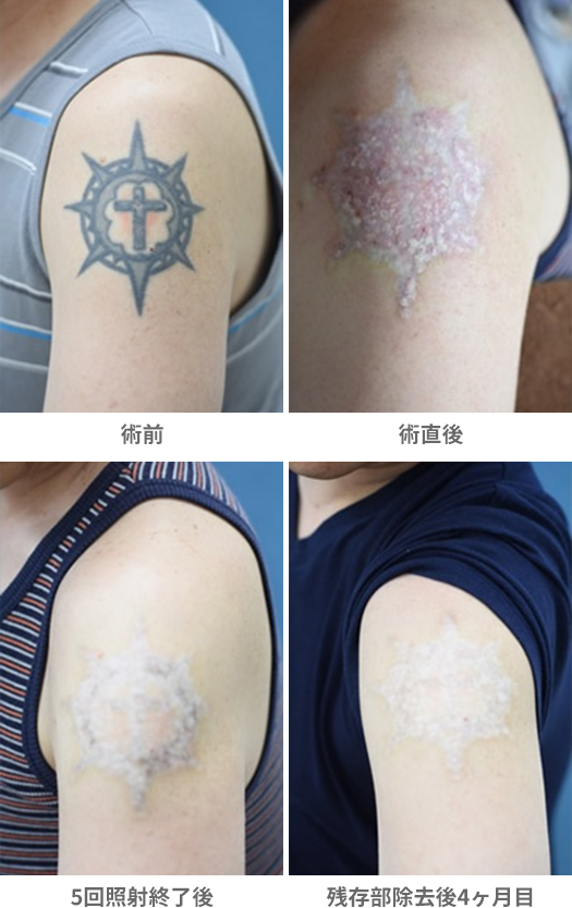 「Qスイッチ・レーザーによる刺青除去」の症例写真・ビフォーアフター