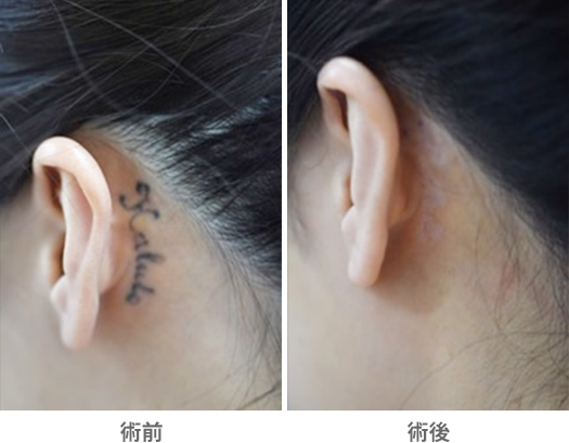 「Qスイッチルビー・レーザーによる刺青除去」の症例写真・ビフォーアフター