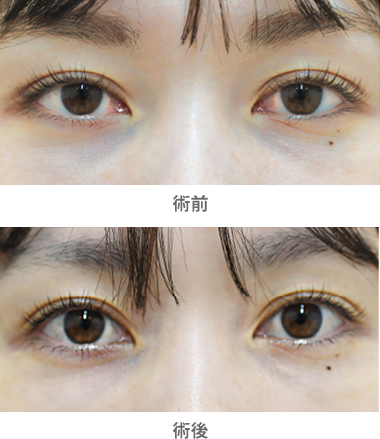「目の下の小じわ・くま改善（ACRS療法）」の症例写真・ビフォーアフター
