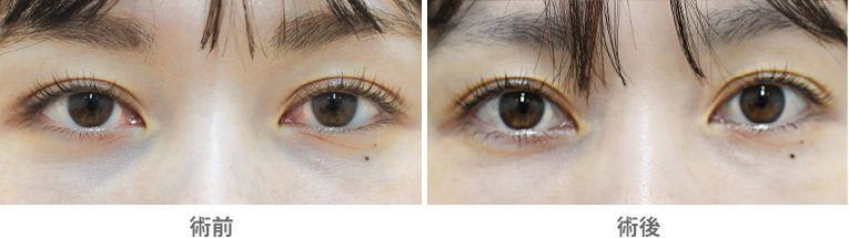 「目の下の小じわ・くま改善（ACRS療法）」の症例写真・ビフォーアフター