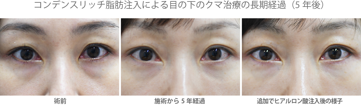 目の下のクマ取り治療における5年経過後の様子