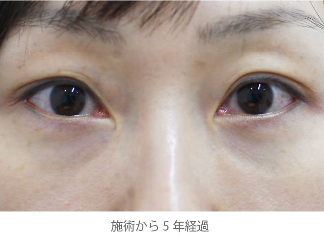 術後①(脂肪注入から5年後)