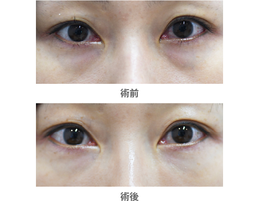「目の下の色クマ・へこみ改善（コンデンスリッチ脂肪注入）」の症例写真・ビフォーアフター