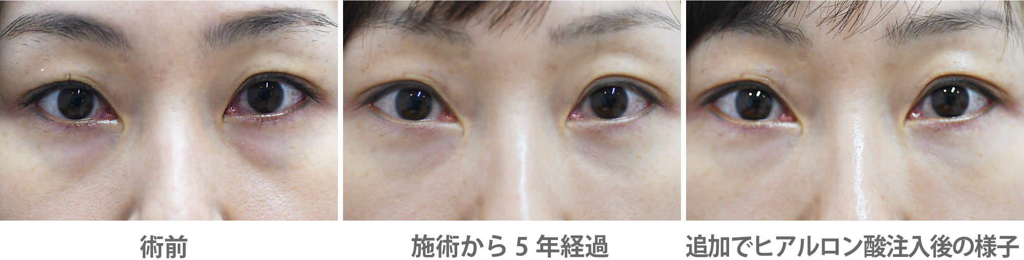 「目の下の色クマ・へこみ改善（コンデンスリッチ脂肪注入）」の症例写真・ビフォーアフター