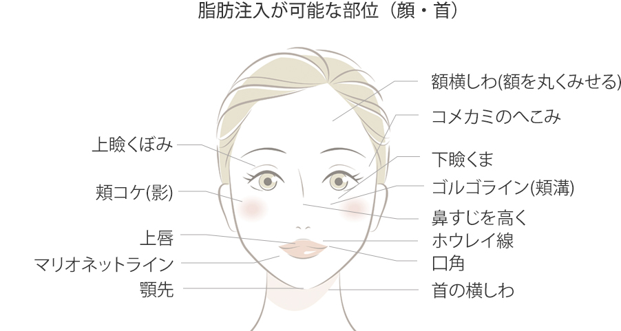 脂肪注入が可能な部位