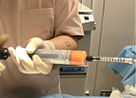 コンデンスリッチファット注入