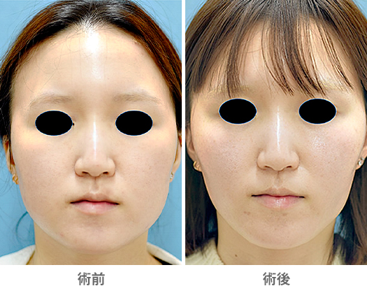 「小顔整形（バッカルファット切除・頬の脂肪吸引）」の症例写真・ビフォーアフター