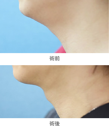 「顎下（首）の脂肪吸引」の症例写真・ビフォーアフター
