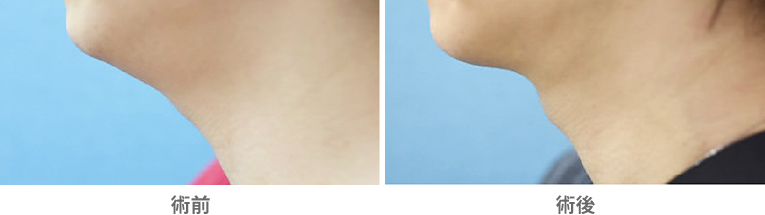 「顎下（首）の脂肪吸引」の症例写真・ビフォーアフター