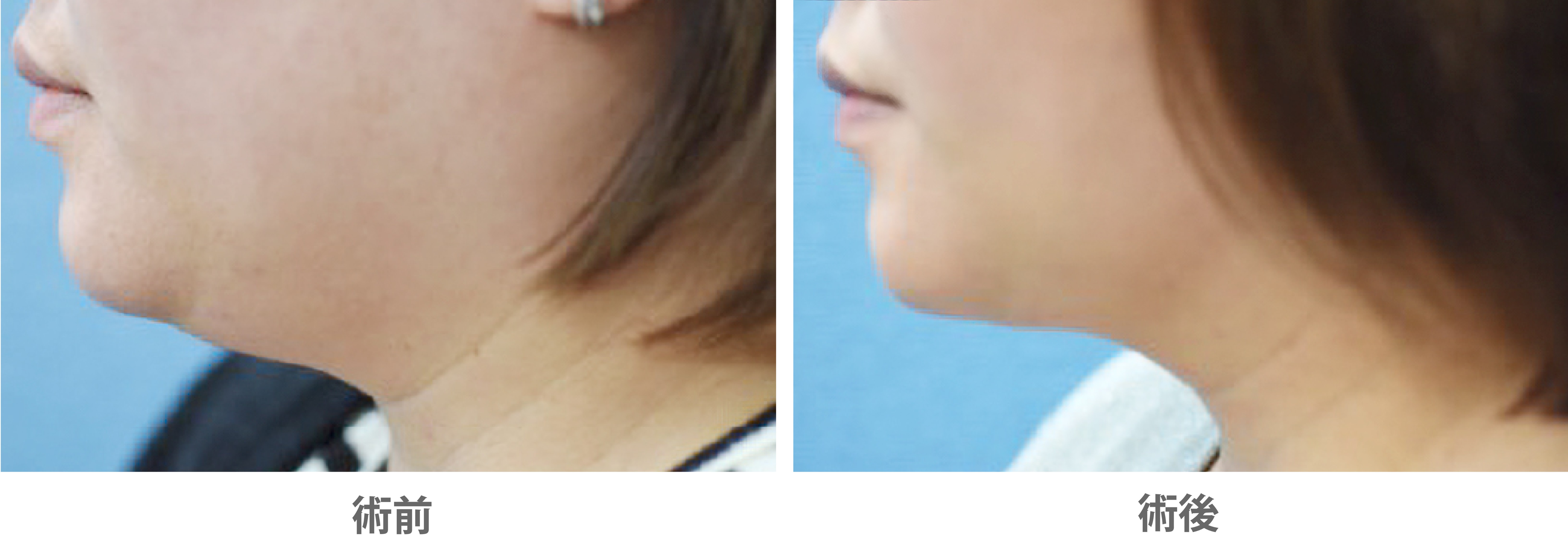 「頬と首の脂肪吸引」の症例写真・ビフォーアフター