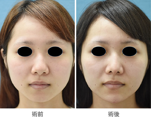 「複合技による小顔整形・シャープな雰囲気に変える」の症例写真・ビフォーアフター