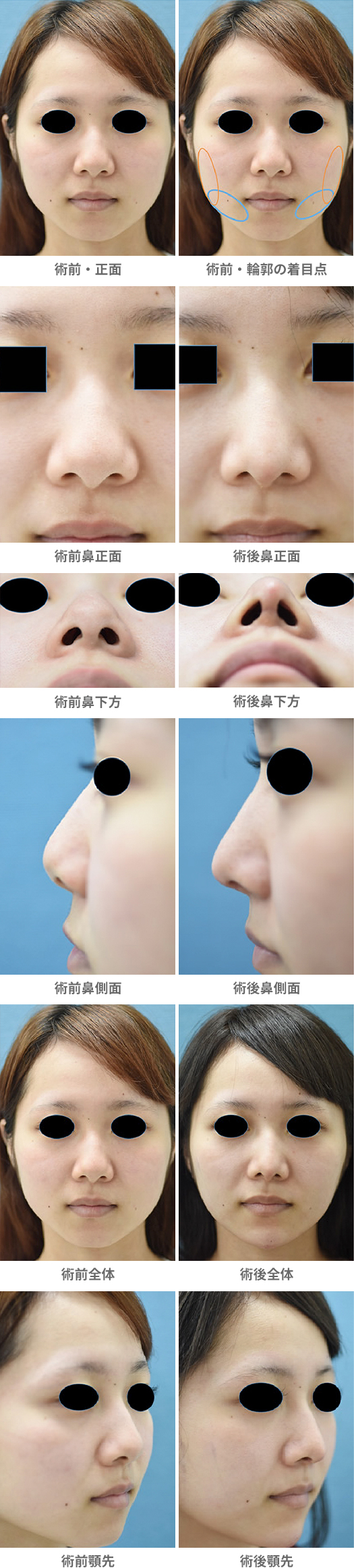 「複合技による小顔整形・シャープな雰囲気に変える」の症例写真・ビフォーアフター