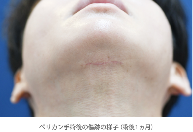 ペリカン手術後の傷跡の様子（術後1ヵ月）