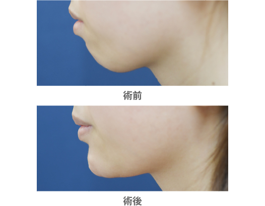 「顎プロテーゼ（プロテーゼで最大限あごを前に出す）」の症例写真・ビフォーアフター