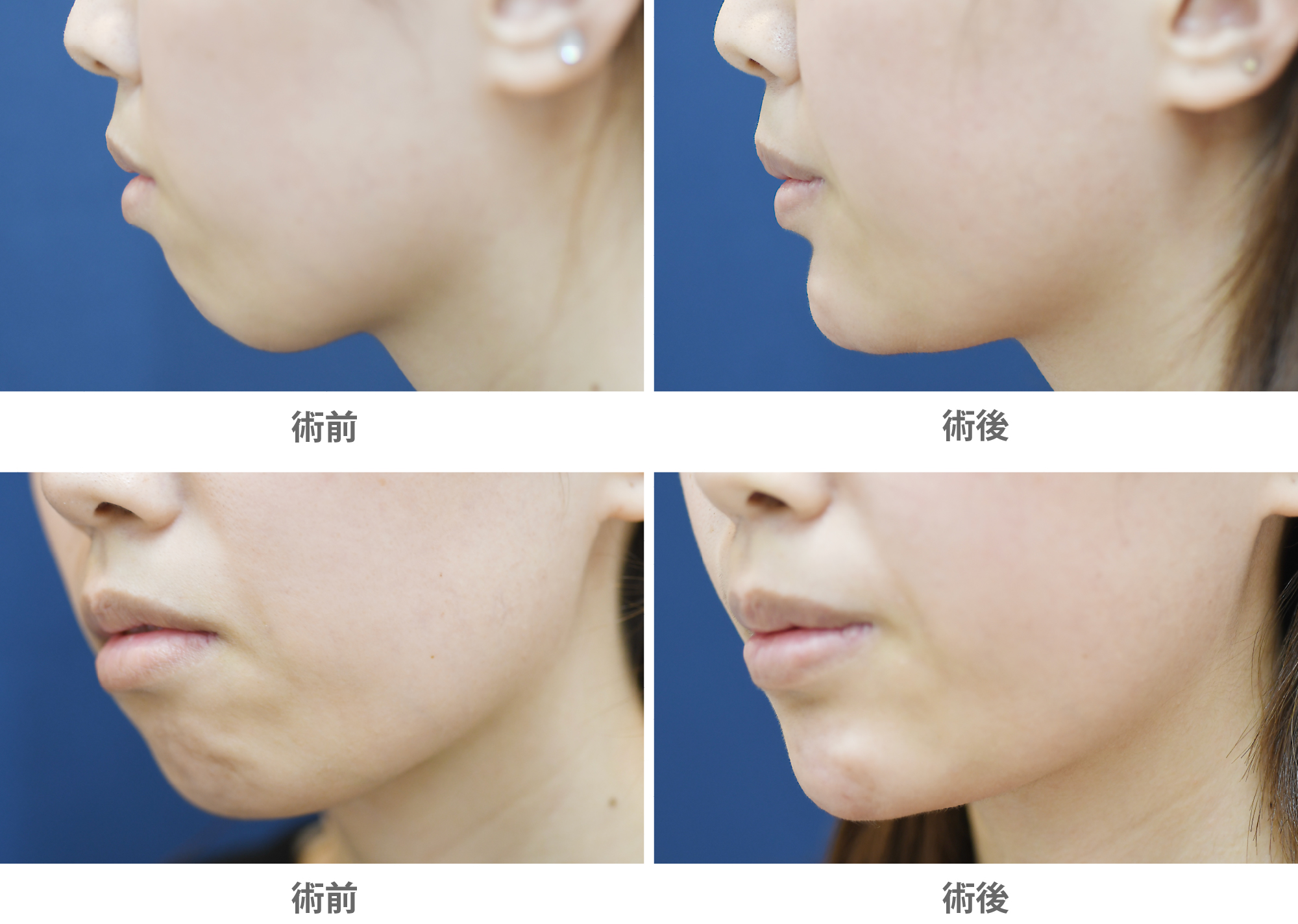 「顎プロテーゼ(プロテーゼで最大限あごを前に出す)」の症例写真・ビフォーアフター