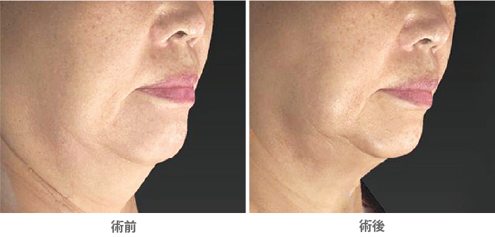 アグネスによる二重顎治療