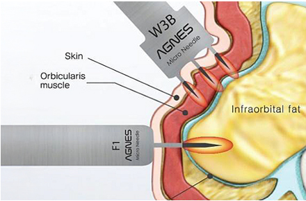 目の下のしわ・たるみに直接アプローチが可能