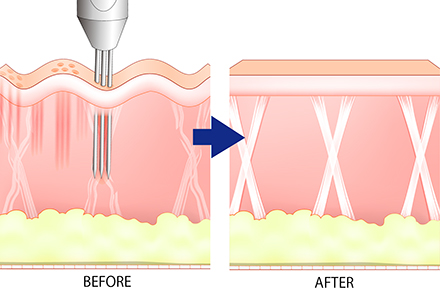 皮膚ダメージを最小限に抑える設計