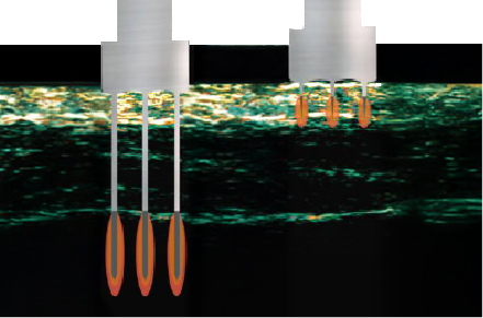 目の下の小じわ or たるみをピンポイントで改善
