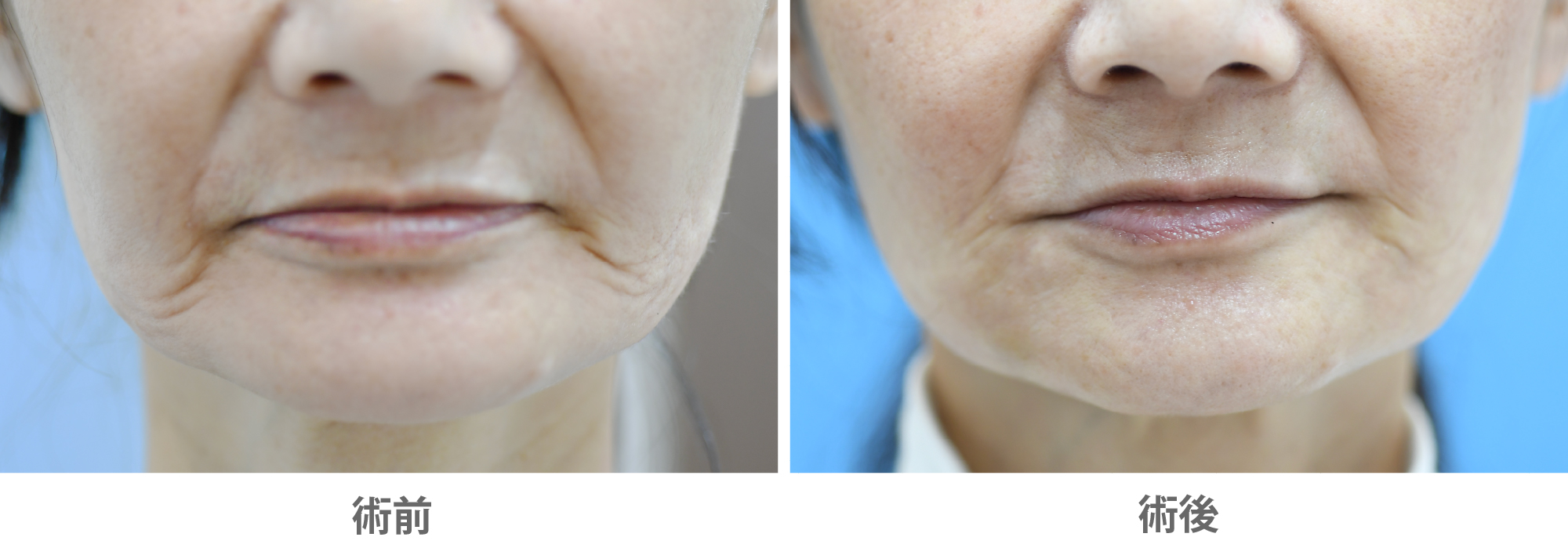 「マリオネットライン・口元のたるみ改善（ヒアルロン酸・ボトックス）」の症例写真・ビフォーアフター