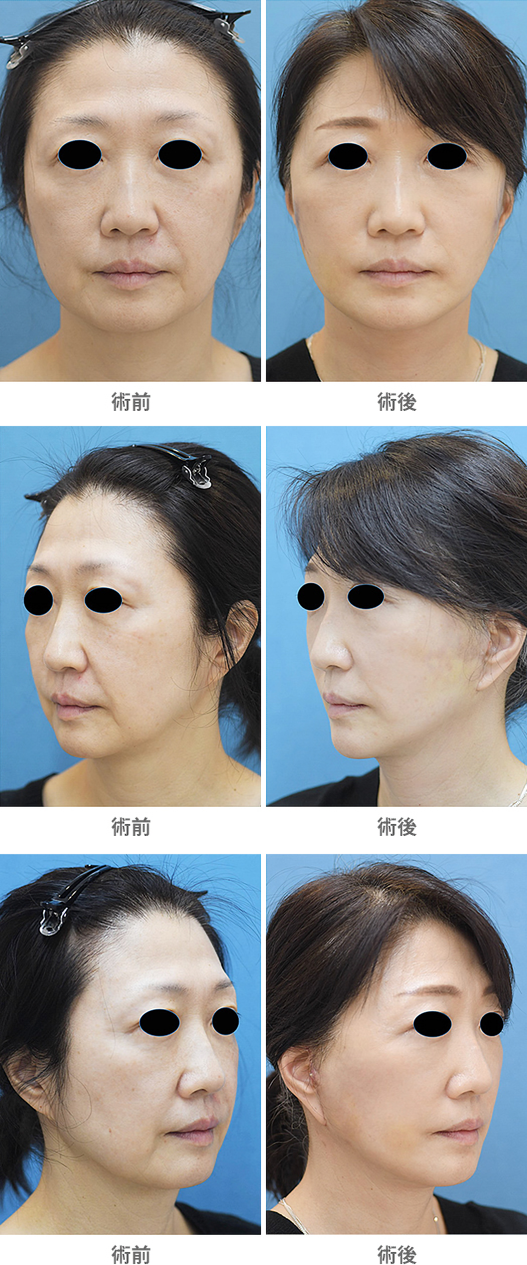 「フルフェイスリフト(中顔面から下顔面のたるみ取り)」の症例写真・ビフォーアフター