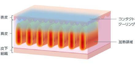 真皮層のみにピンポイント照射が可能