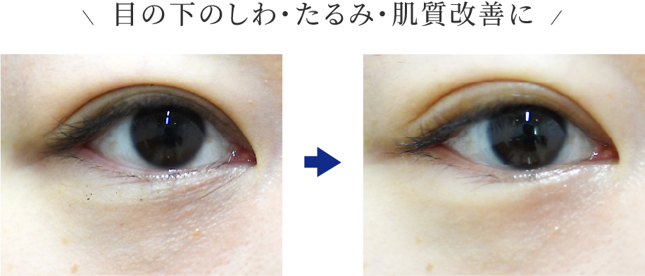 目の下のしわ・たるみ・肌質改善に