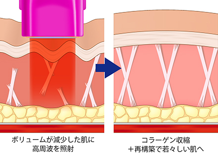 術後は6~12か月程度効果が持続