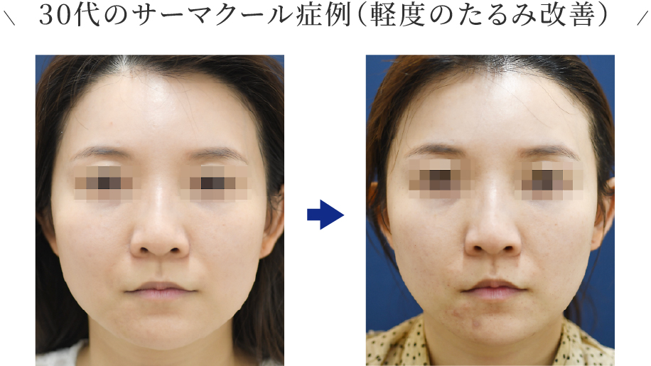 サーマクールFLX（高周波） | 池袋の美容皮膚科・美容外科ならみずほ