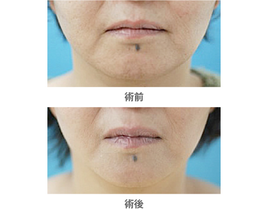 「ウルセラ（HIFU）によるたるみ治療」の症例写真・ビフォーアフター