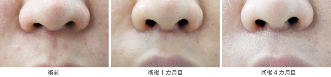 「人中短縮後の傷跡①/筋肉・ASN処理あり」の症例写真・ビフォーアフター